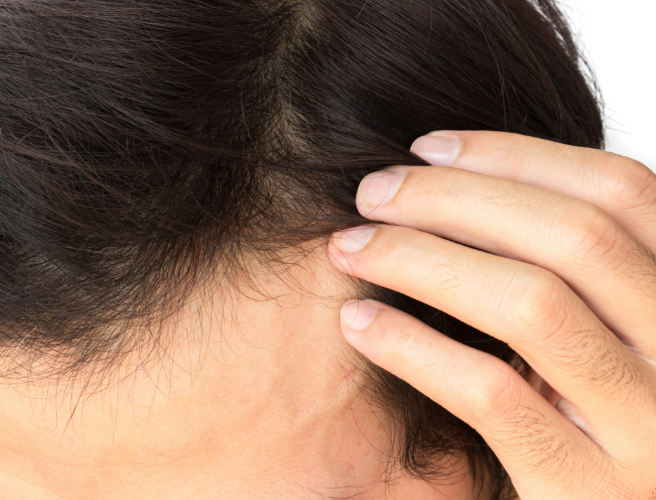 男性型脱毛症(AGA・エージーエー)